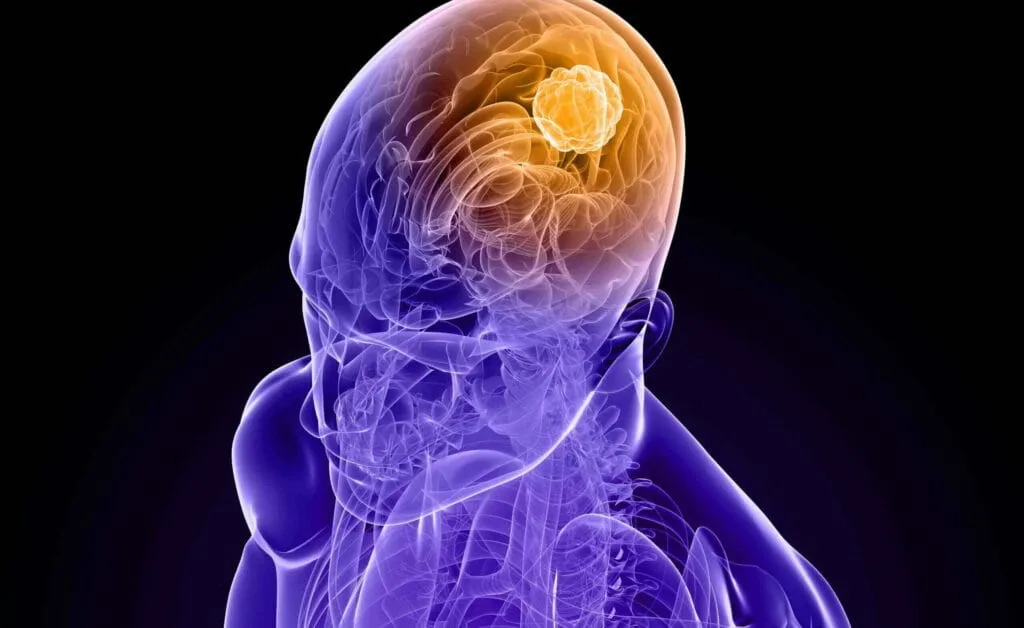 tumore al cervello scaled 1