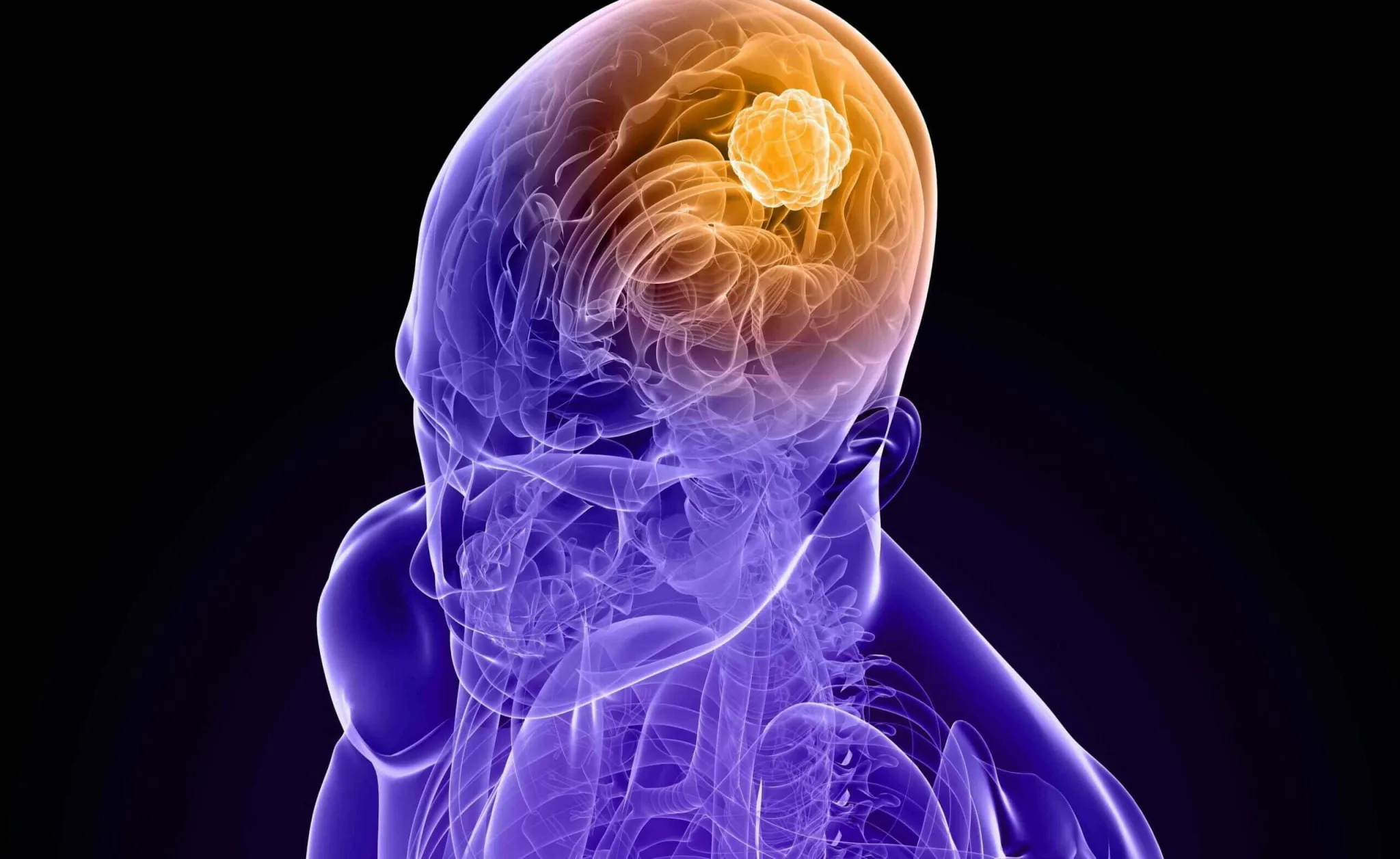 tumore al cervello scaled 1